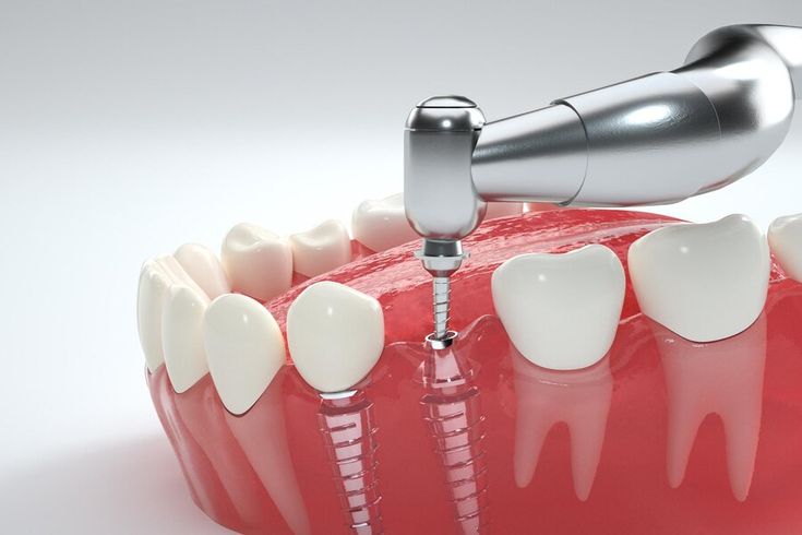 trồng răng implant yenle dental
